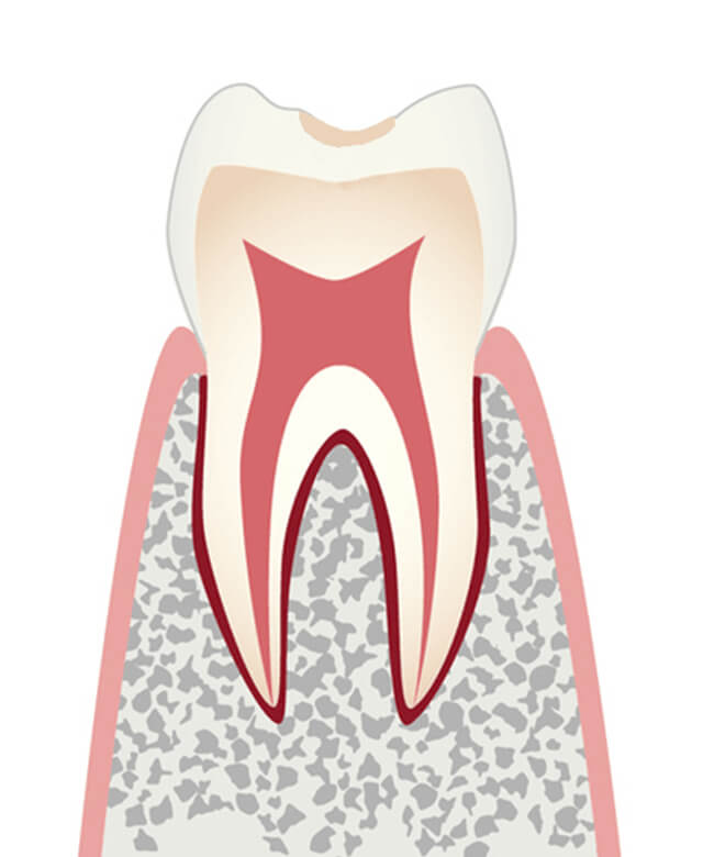 初期のむし歯のイラスト