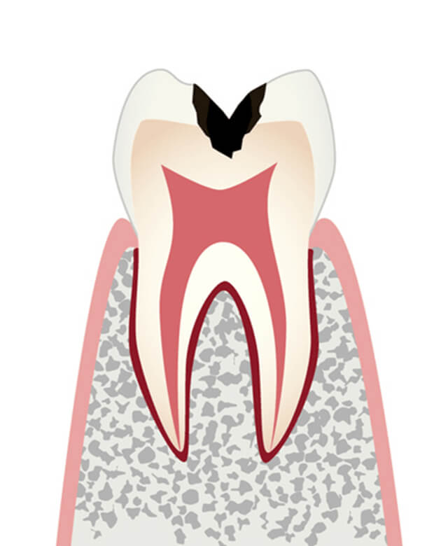 歯の内部まで進行したむし歯のイラスト